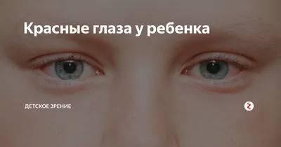 Красные глаза после наращивания – почему это происходит