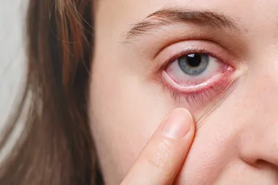 Красные глаза — причины покраснения, что делать, как лечить, профилактика