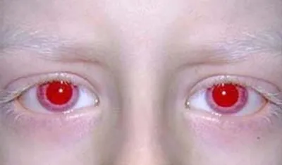 Конюнктивит, уставшие глаза, красные глаза, заболевание глаза Стоковое  Изображение - изображение насчитывающей ресницы, аллергически: 137539987