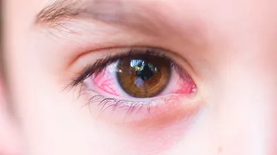 Когда краснеют глаза: насколько это серьезно? | doc.ua