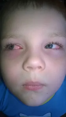 Капли для глаз Alcon Опатанол. - «Опатанол - глазные капли, применение у  ребенка. Лечим красные глазки. » | отзывы