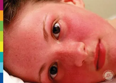 Тревога может вызвать красные пятна на коже | Советы от психотерапевта |  Дзен