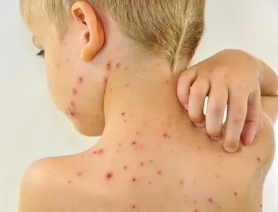 Типы кожных заболеваний. Виды болезней кожи у детей