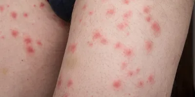 Аллергия на лице у взрослых и детей: что делать и чем лечить сыпь на коже