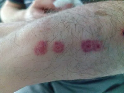 Rosea Pityriasis. Герпес. Красные пятна на коже. Аллергия. Слабая иммунитет  Стоковое Изображение - изображение насчитывающей раздражение,  аллергическая: 205547429