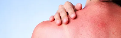 Аллергия на солнце: как выглядит, как проявляется, лечение | РБК Стиль