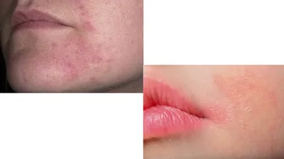 Красные пятна на лице: у тебя купероз? Читай в блоге Face Bar