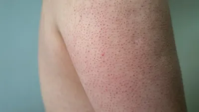 Как лечить сыпь на коже после Ковид-19 | Солнышко