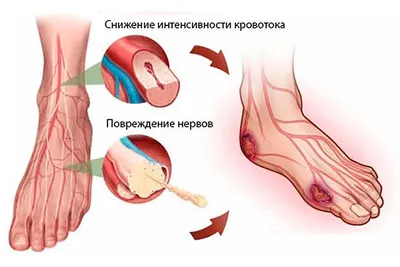 Лечение диабетической ангиопатии нижних конечностей | Солнышко