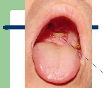 Почему развивается кандидоз слизистой рта? Обзор всех клинических форм -  parodont.pro