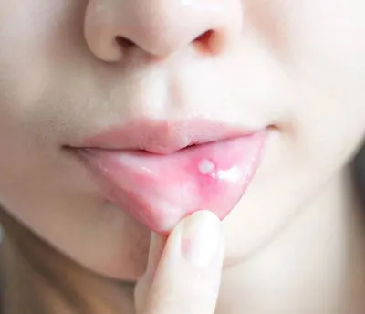 Молочница во рту: симптомы кандидоза полости рта, лечение стоматита у  взрослых препаратами и стоматологом