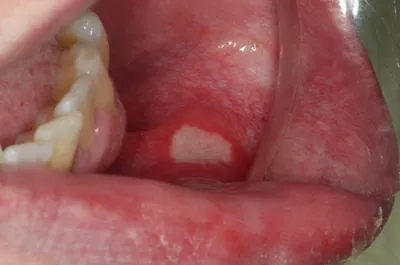Почему появляются белые пятна во рту? 6 возможных причин | Стоматология  ROOTT | Дзен