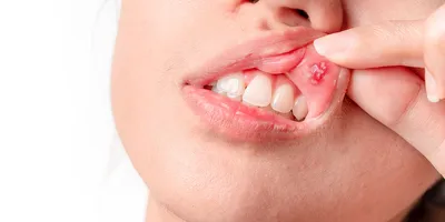 ВИЧ и СПИД: что нужно знать стоматологам? (опыт США) (2537) - Стоматология  - Новости и статьи по стоматологии - Профессиональный стоматологический  портал (сайт) «Клуб стоматологов»