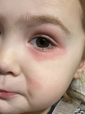 Прошу помощи или красные пятна на лице у дочки | Пикабу
