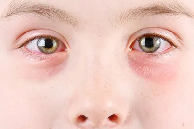 Красные пятна под глазами и на лбу — 17 ответов | форум Babyblog