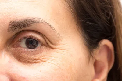 Шелушение под глазами и вокруг глаз - причины и лечение -  Офтальмологические клиники «Эксимер» (Одесса) - диагностика и лечение  заболеваний глаз у взрослых и детей