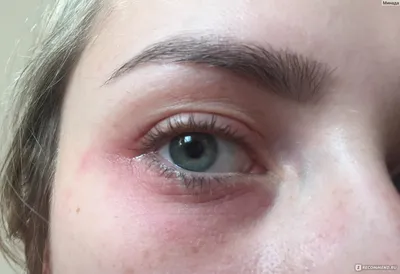 Сыворотка-корректор морщин Avon Anew Clinical PRO+ новая формула - «Ужасная  аллергия! Не подходит девушкам с чувствительной кожей вокруг глаз!» | отзывы