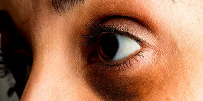 Красные пятна под глазами или вокруг глаз: причины, диагностика и лечение
