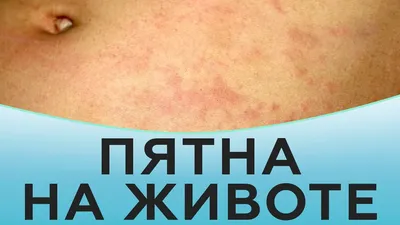 Что это за пятна? На теле появились пятна, сначала около подмышки, но |  MedAboutMe