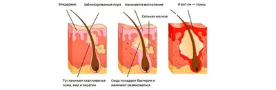 Всё о язвах во рту - причины, лечение, профилактика - блог «ДИНАСТИЯ»