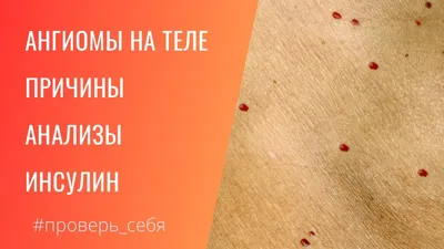 Что означают красные родинки на коже? | Советы, Кожа, Рецепты