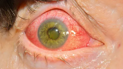 Покраснение глаз – первый симптом ковида? – [Клиника доктора Куренкова]
