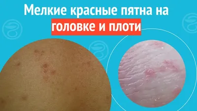 Красные пятна на головке члена у мужчин: причины, лечение и профилактика |  Новости здоровья