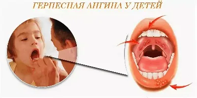 Воспалительные заболевания десен: стоматит, свищ, киста - причины и лечение