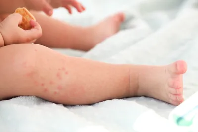 Красные пятна на коже: появились и чешутся после укусов, на коже рук, ног у  детей и взрослых