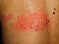 Аллергия на коже: симптомы и причины | Диагностика и лечение кожной  аллергии в АО «Медицина»