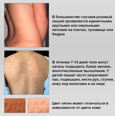 Красный плоский лишай: симптомы, лечение в Киеве. Цена консультации  дерматовенеролога.