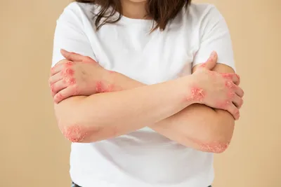 Naftalan Products - Красный плоский лишай - хроническое воспалительное  заболевание, которое может поражать не только кожу, но и волосы, ногти,  слизистые оболочки. К симптомам красного плоского лишая относятся:  симметричные красные или фиолетовые