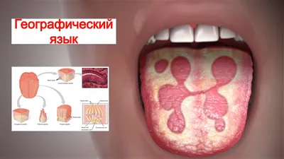 Симптомы аллергии на стоматологические материалы