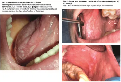 Проблема диагностики красного плоского лишая при поражении слизистой  оболочки полости рта - Грабовская - Российский журнал кожных и венерических  болезней