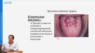 Красный плоский лишай в полости рта: лечение