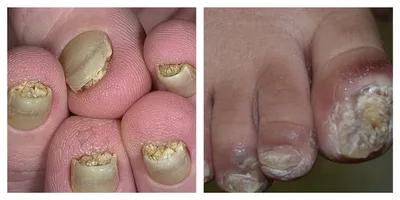 Заболевания ногтей | Медицинский центр Аванта-Мед