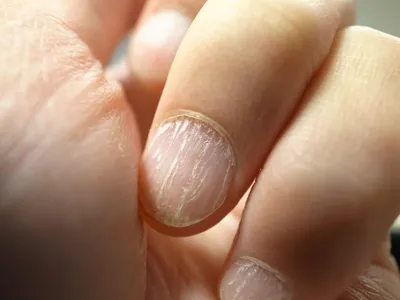Утолщенные ногти: особенности аппаратного педикюра - pro.bhub.com.ua