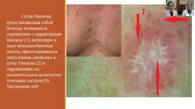 Красный плоский лишай: симптомы, лечение в Киеве. Цена консультации  дерматовенеролога.