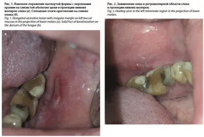Оптимизация комплексной терапии красного плоского лишая слизистой оболочки полости  рта - DENTALMAGAZINE.RU