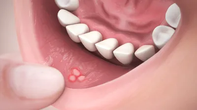 Squamous cell carcinoma in a patient with lichen planus of the oral mucosa  - Kubanov - Vestnik dermatologii i venerologii