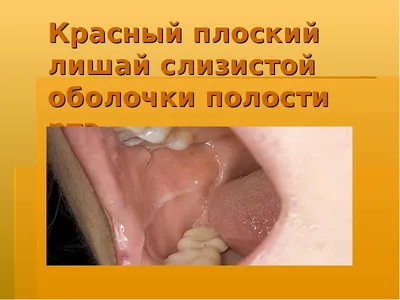 Изолированное поражение языка красным плоским лишаем - DENTALMAGAZINE.RU