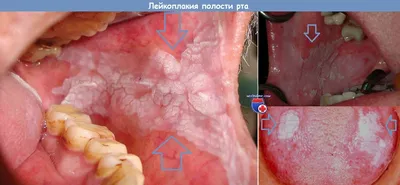 Красный плоский лишай слизистой оболочки полости рта : руководство для  врачей - Демьяненко С.А., Колесник В.М., Андрианова И.И., Тофан Ю.В.,  Купить c быстрой доставкой или самовывозом, ISBN 978-5-9704-8005-2 - КомБук  (Combook.RU)