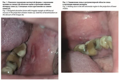 Случай №30. Красный плоский лишай 3.0…или что-то во рту. | Сайт  дерматовенеролога Бетехтина М.С.