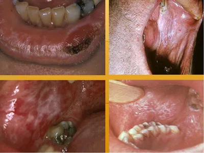 Оптимизация комплексной терапии красного плоского лишая слизистой оболочки  полости рта - DENTALMAGAZINE.RU