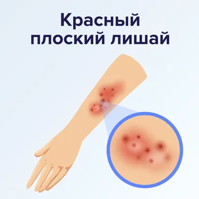 Рак языка: симптомы, диагностика, лечение опухоли, операция в Москве
