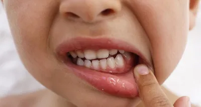 Гноится десна после удаления зуба — 4 причины, 5 симптомов и лечение |  Dental Art