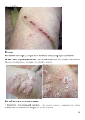 Симптомы заболеваний кожи - кратко с точки зрения внутренних болезней