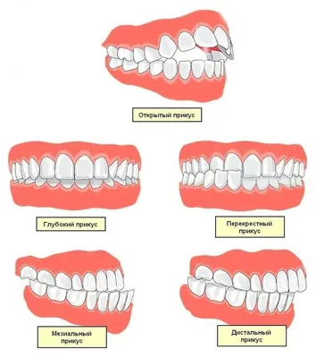 Как определить правильный прикус? - блог стоматологии