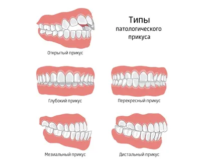 Неправильный прикус профилактика и лечение в Севастополе | Стоматология  Жемчуг