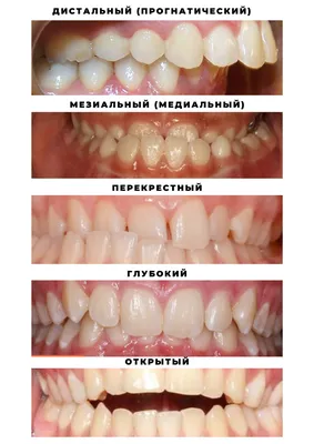 Неправильное положение зубов и челюстей: причины и лечение